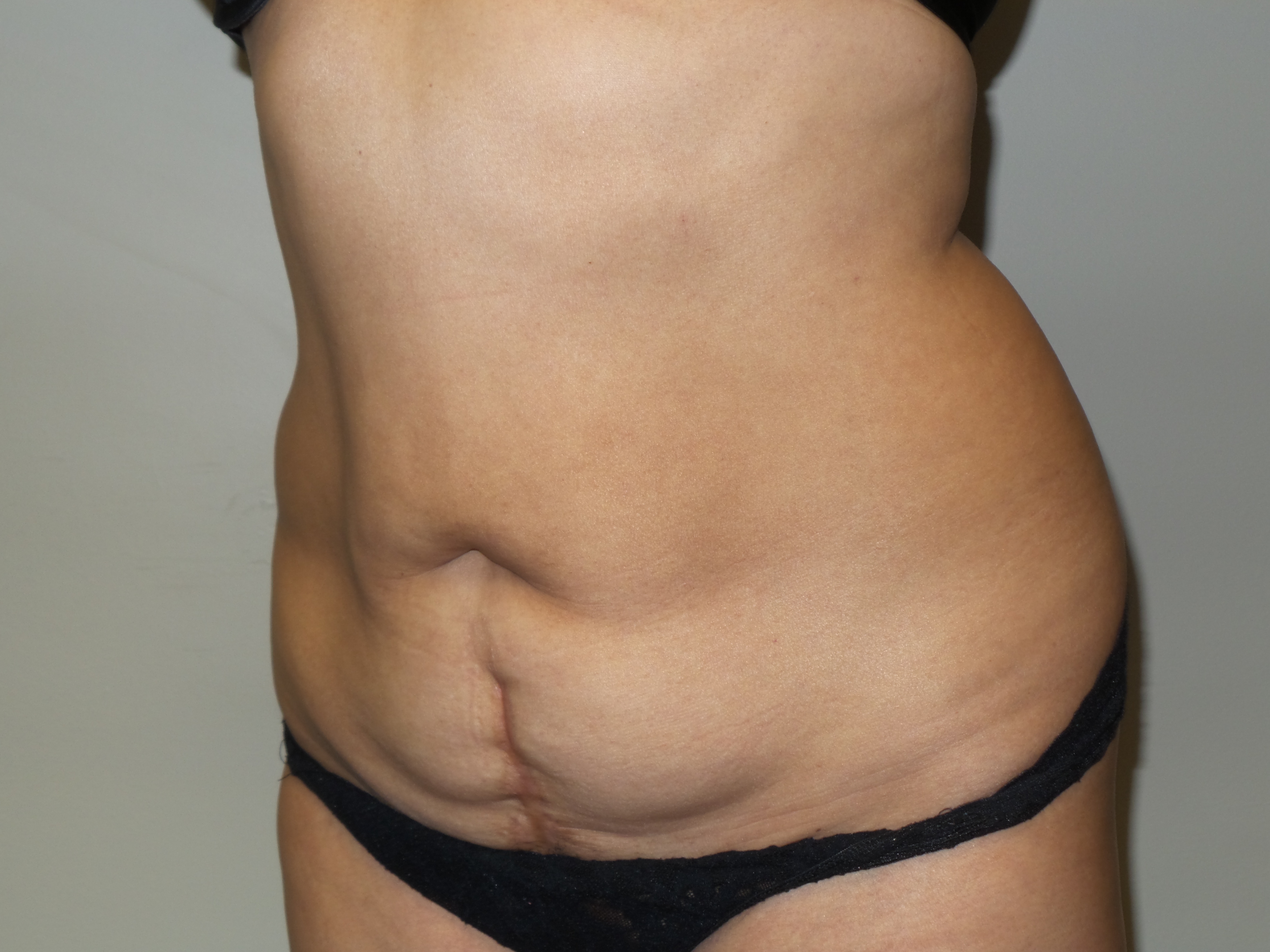 Tummy Tuck Before and After 26 | Sanjay Grover MD FACS