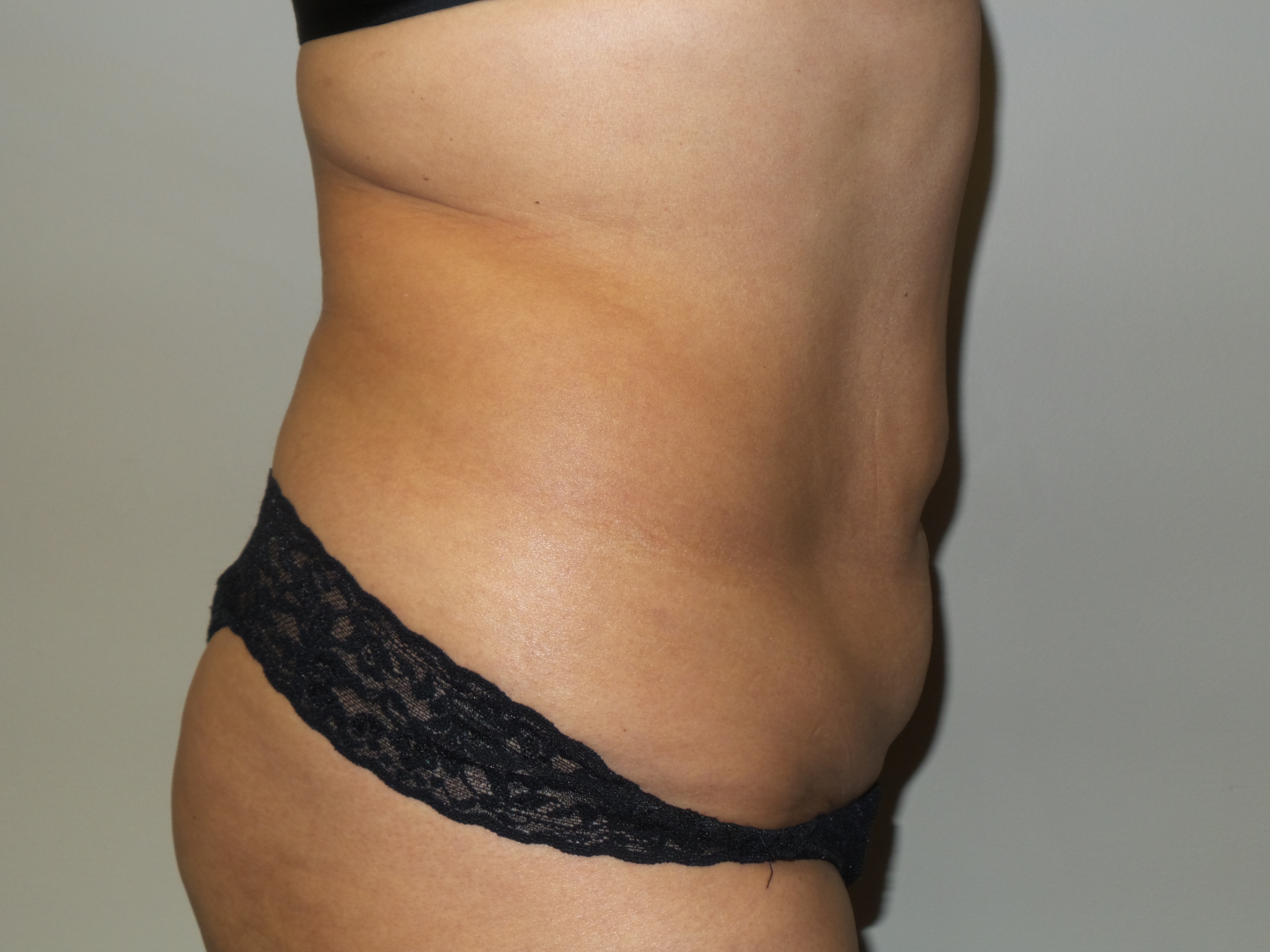 Tummy Tuck Before and After 26 | Sanjay Grover MD FACS