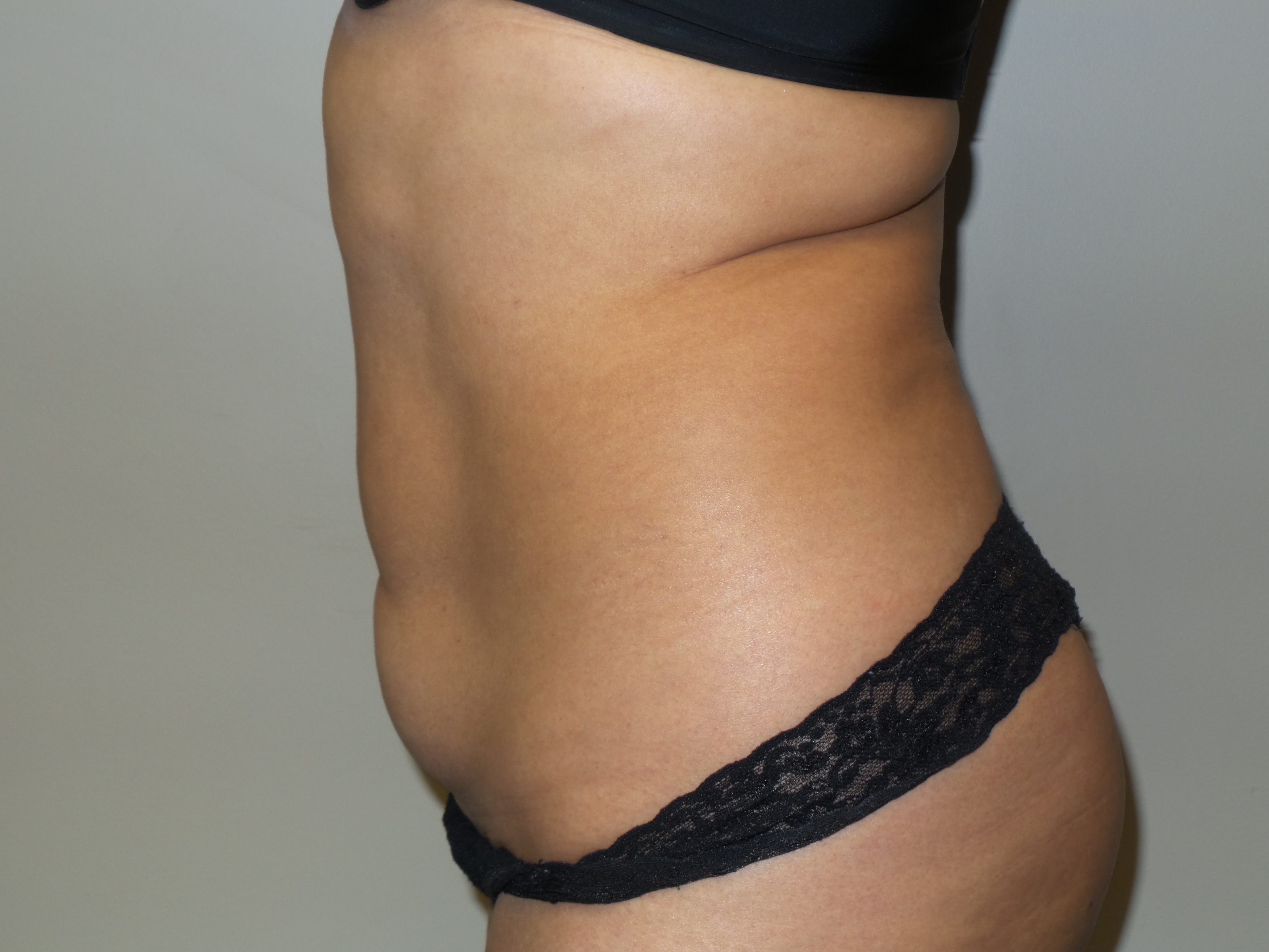 Tummy Tuck Before and After 26 | Sanjay Grover MD FACS