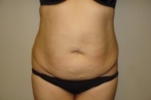 Tummy Tuck Before and After | Grover Aesthetics