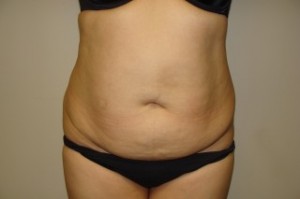 Tummy Tuck Before and After | Sanjay Grover MD FACS