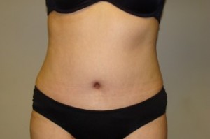 Tummy Tuck Before and After | Grover Aesthetics