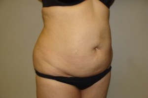 Tummy Tuck Before and After 27 | Grover Aesthetics