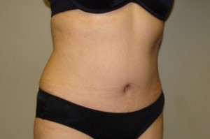 Tummy Tuck Before and After 27 | Grover Aesthetics