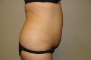 Tummy Tuck Before and After 27 | Grover Aesthetics