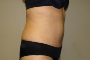 Tummy Tuck Before and After 27 | Grover Aesthetics