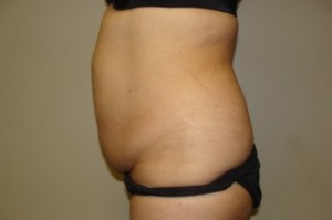 Tummy Tuck Before and After 27 | Grover Aesthetics