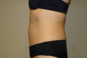Tummy Tuck Before and After 27 | Grover Aesthetics