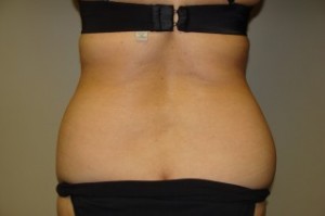 Tummy Tuck Before and After 27 | Grover Aesthetics