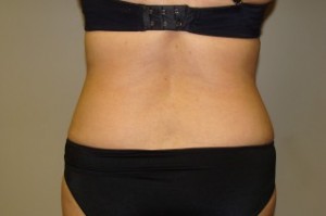 Tummy Tuck Before and After 27 | Grover Aesthetics