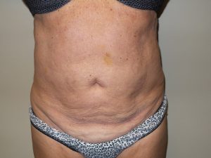 Tummy Tuck Before and After 55 | Sanjay Grover MD FACS