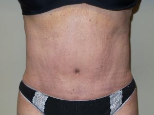 Tummy Tuck Before and After | Grover Aesthetics