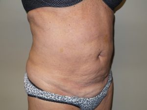 Tummy Tuck Before and After 28 | Sanjay Grover MD FACS