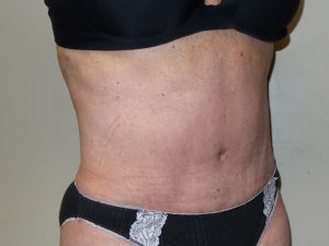 Tummy Tuck Before and After 28 | Sanjay Grover MD FACS