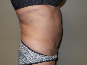 Tummy Tuck Before and After 28 | Sanjay Grover MD FACS