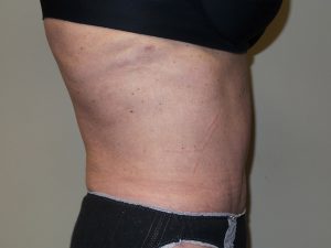 Tummy Tuck Before and After 28 | Sanjay Grover MD FACS