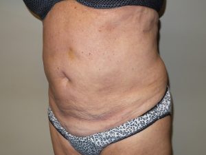 Tummy Tuck Before and After 28 | Sanjay Grover MD FACS