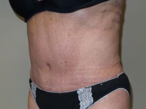 Tummy Tuck Before and After 28 | Sanjay Grover MD FACS