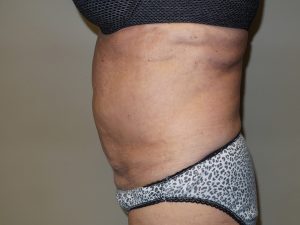 Tummy Tuck Before and After 28 | Sanjay Grover MD FACS