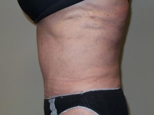 Tummy Tuck Before and After 28 | Sanjay Grover MD FACS