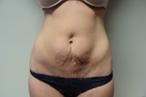 Tummy Tuck Before and After | Grover Aesthetics