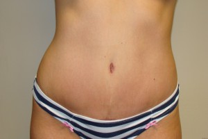 Tummy Tuck Before and After | Grover Aesthetics