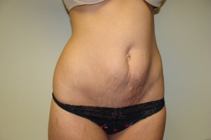 Tummy Tuck Before and After 29 | Grover Aesthetics