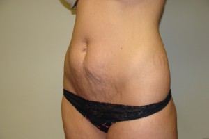 Tummy Tuck Before and After 29 | Grover Aesthetics