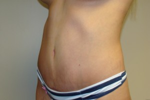 Tummy Tuck Before and After 29 | Grover Aesthetics