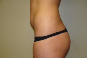 Tummy Tuck Before and After 29 | Grover Aesthetics