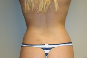 Tummy Tuck Before and After 29 | Grover Aesthetics