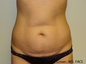 Tummy Tuck Before and After 76 | Sanjay Grover MD FACS
