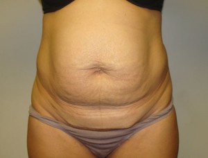 Tummy Tuck Before and After 09 | Sanjay Grover MD FACS