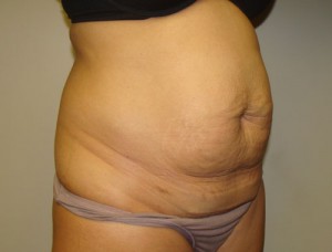 Tummy Tuck Before and After 30 | Grover Aesthetics