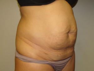 Tummy Tuck Before and After 30 | Sanjay Grover MD FACS