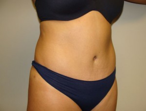 Tummy Tuck Before and After 30 | Sanjay Grover MD FACS