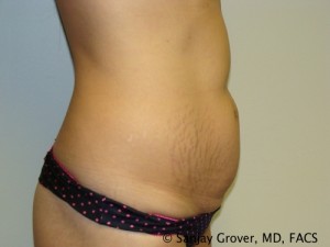Tummy Tuck Before and After 30 | Sanjay Grover MD FACS