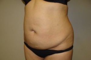 Tummy Tuck Before and After 30 | Grover Aesthetics