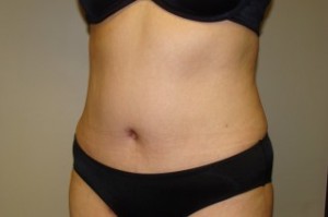 Tummy Tuck Before and After 30 | Grover Aesthetics