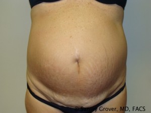 Tummy Tuck Before and After 10 | Sanjay Grover MD FACS