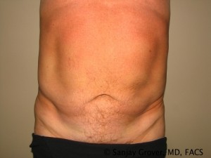 Tummy Tuck Before and After | Grover Aesthetics