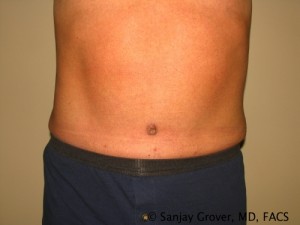 Tummy Tuck Before and After | Grover Aesthetics