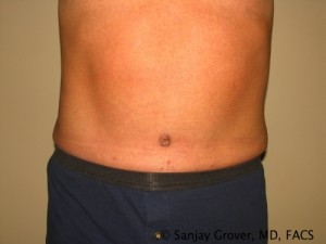 Tummy Tuck Before and After 31 | Sanjay Grover MD FACS