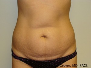 Tummy Tuck Before and After | Grover Aesthetics