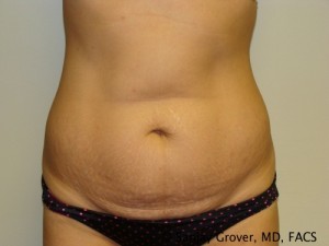 Tummy Tuck Before and After 23 | Sanjay Grover MD FACS