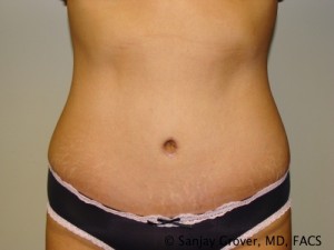Tummy Tuck Before and After | Grover Aesthetics