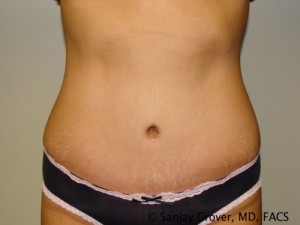 Tummy Tuck Before and After 32 | Sanjay Grover MD FACS