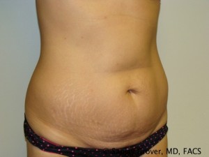 Tummy Tuck Before and After 32 | Grover Aesthetics