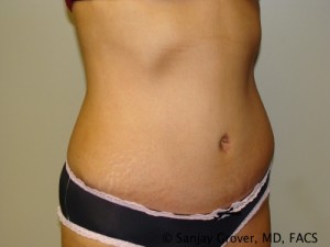 Tummy Tuck Before and After 32 | Sanjay Grover MD FACS