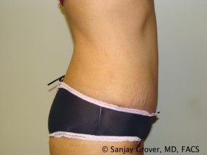 Tummy Tuck Before and After 32 | Grover Aesthetics